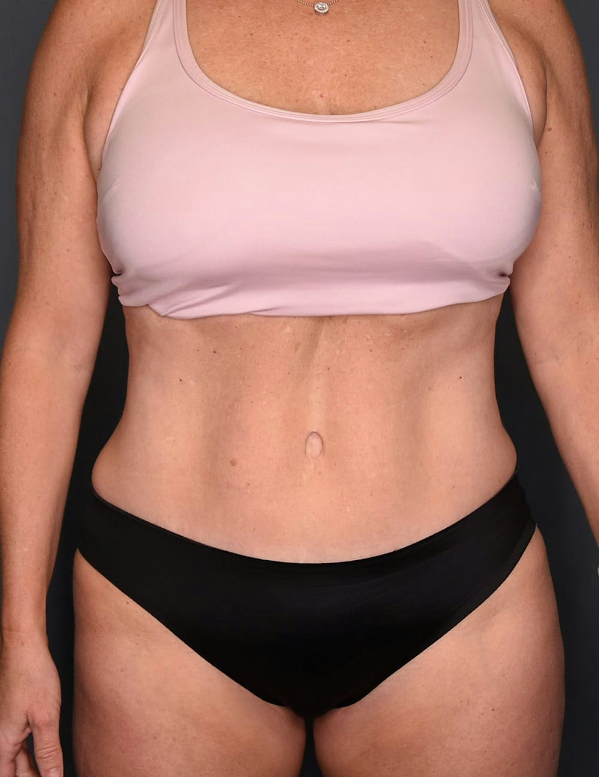 Tummy Tuck Before & After Gallery - Patient 182561 - Image 2