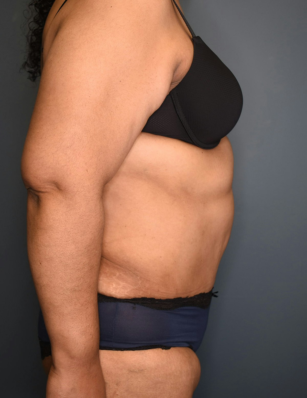 Tummy Tuck Before & After Gallery - Patient 174996 - Image 6