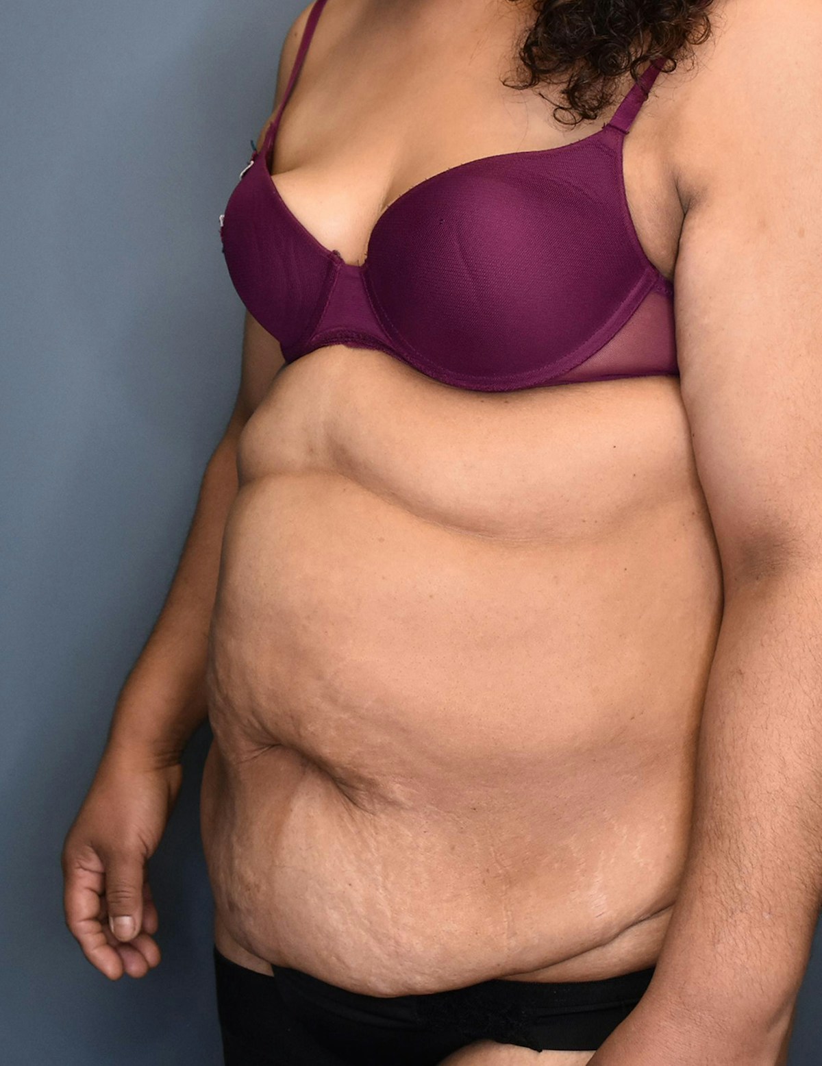 Tummy Tuck Before & After Gallery - Patient 174996 - Image 3