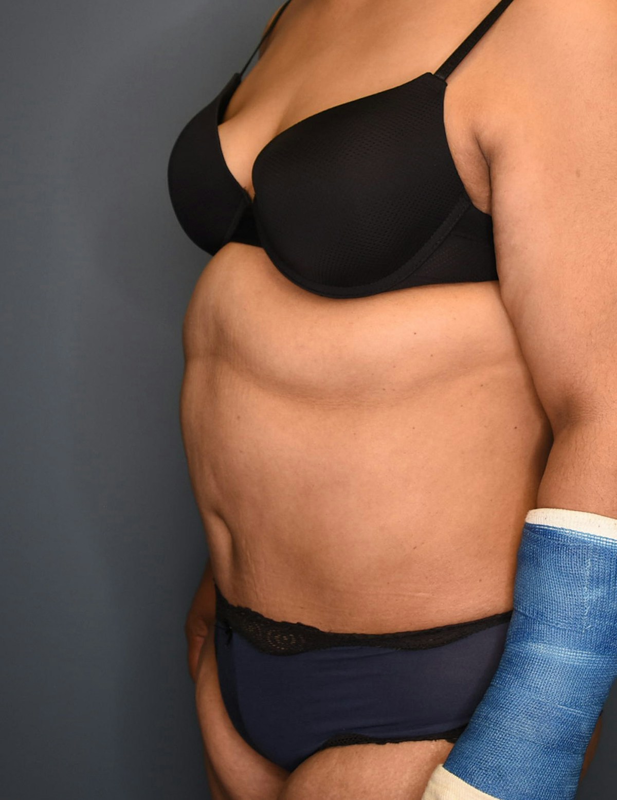 Tummy Tuck Before & After Gallery - Patient 174996 - Image 4