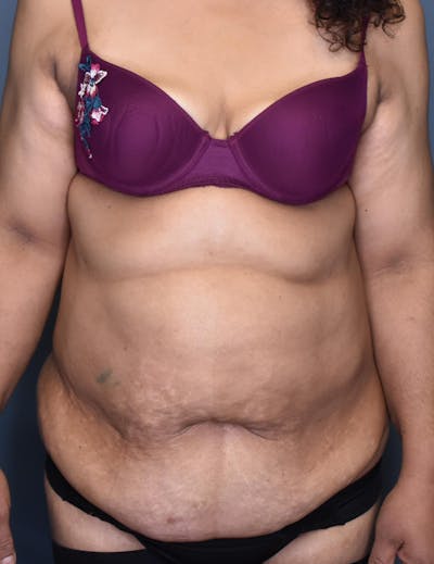 Tummy Tuck Before & After Gallery - Patient 174996 - Image 1