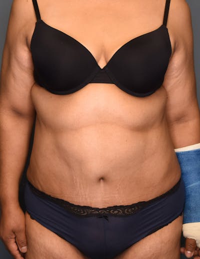 Tummy Tuck Before & After Gallery - Patient 174996 - Image 2