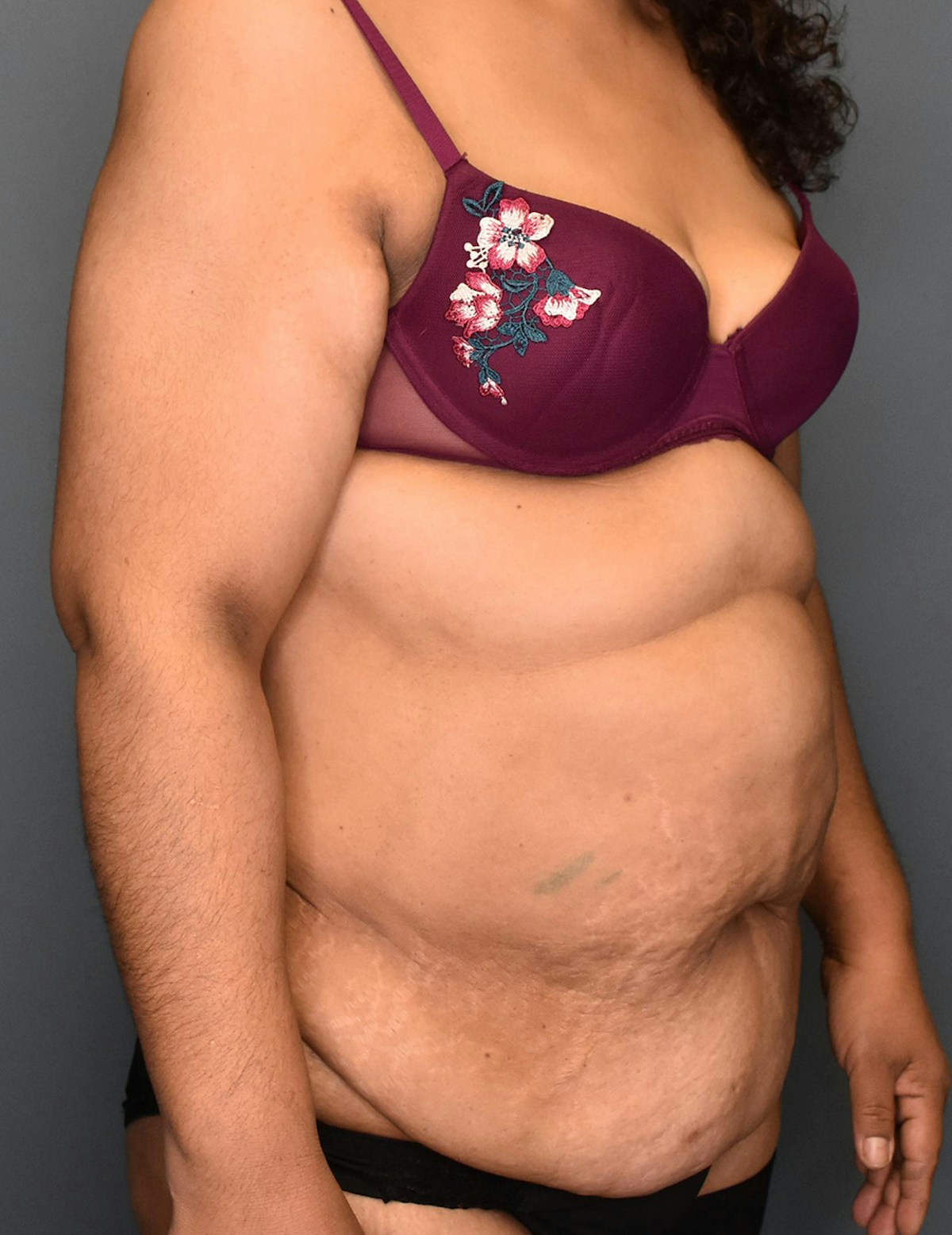 Tummy Tuck Before & After Gallery - Patient 174996 - Image 7