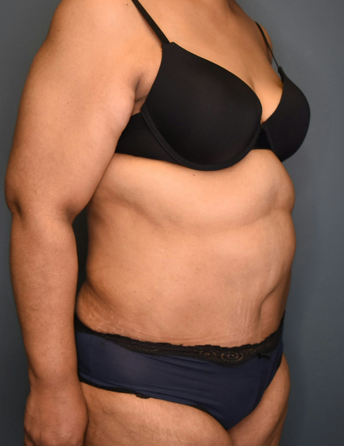 Tummy Tuck Before & After Gallery - Patient 174996 - Image 8