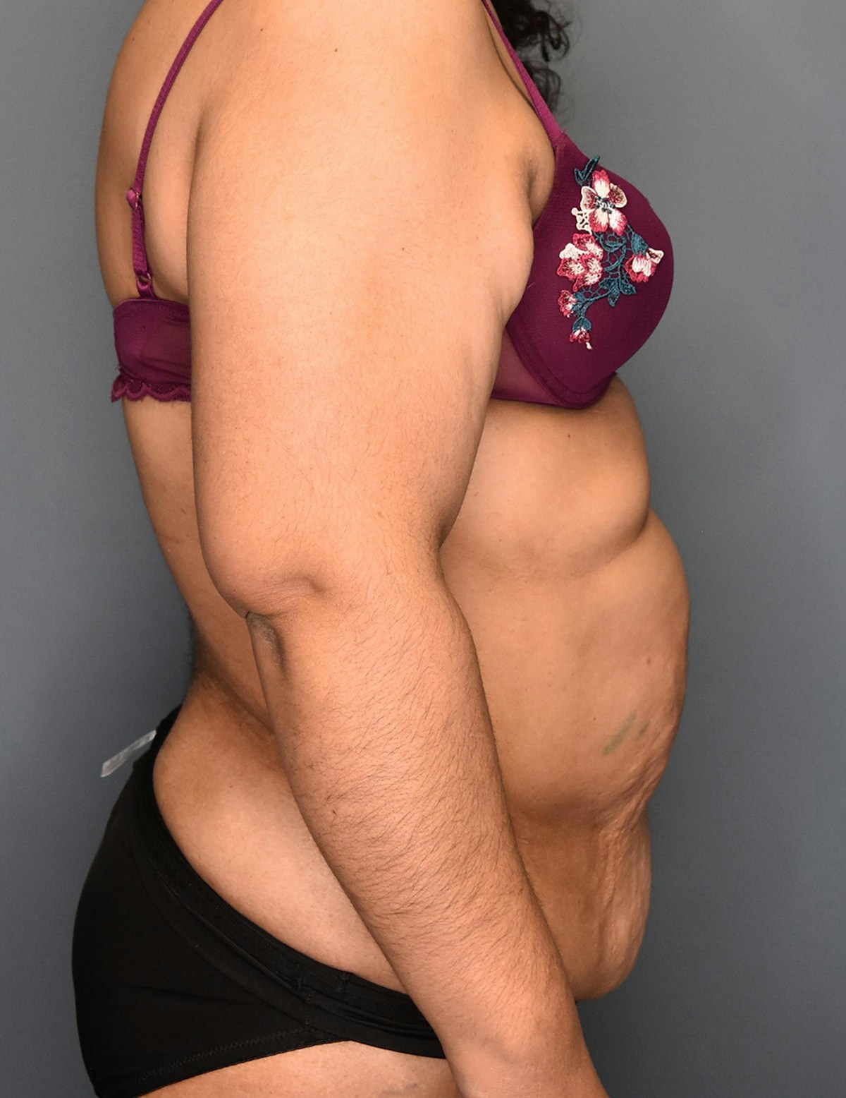 Tummy Tuck Before & After Gallery - Patient 174996 - Image 5