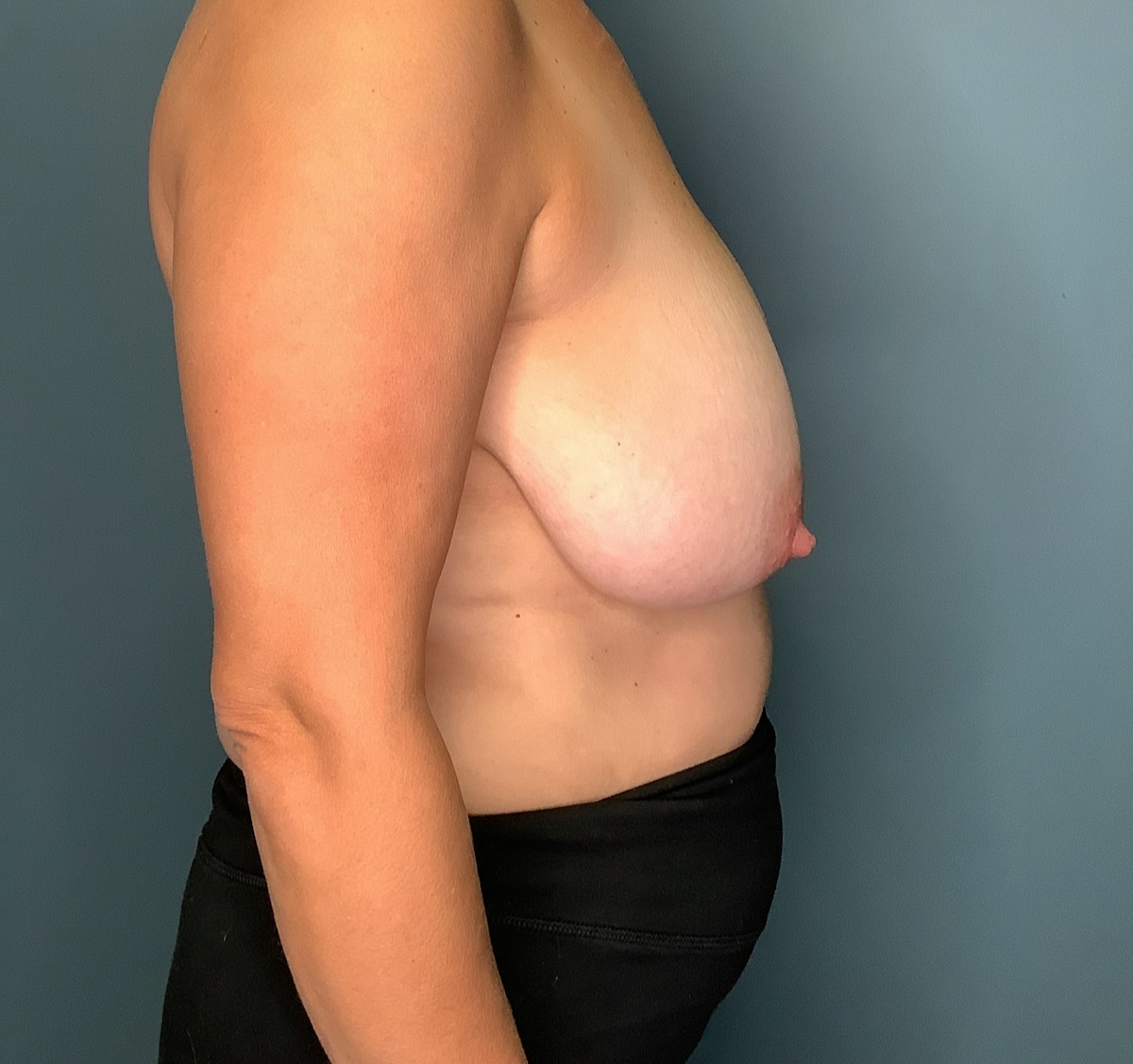 Breast Reduction Before & After Gallery - Patient 142434 - Image 1