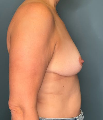 Breast Reduction Before & After Gallery - Patient 142434 - Image 2