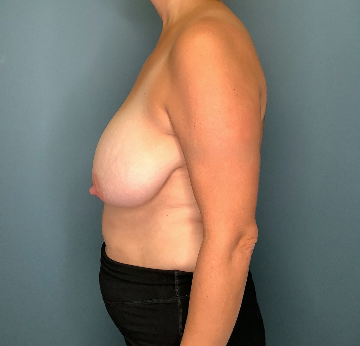 Breast Reduction Before & After Gallery - Patient 142434 - Image 5