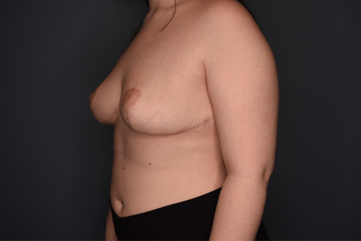 Breast Reduction Before & After Gallery - Patient 219006 - Image 4