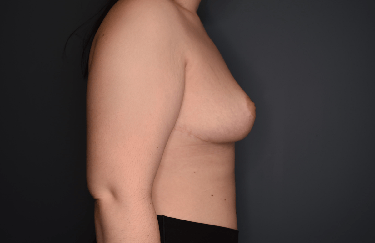 Breast Reduction Before & After Gallery - Patient 219006 - Image 6