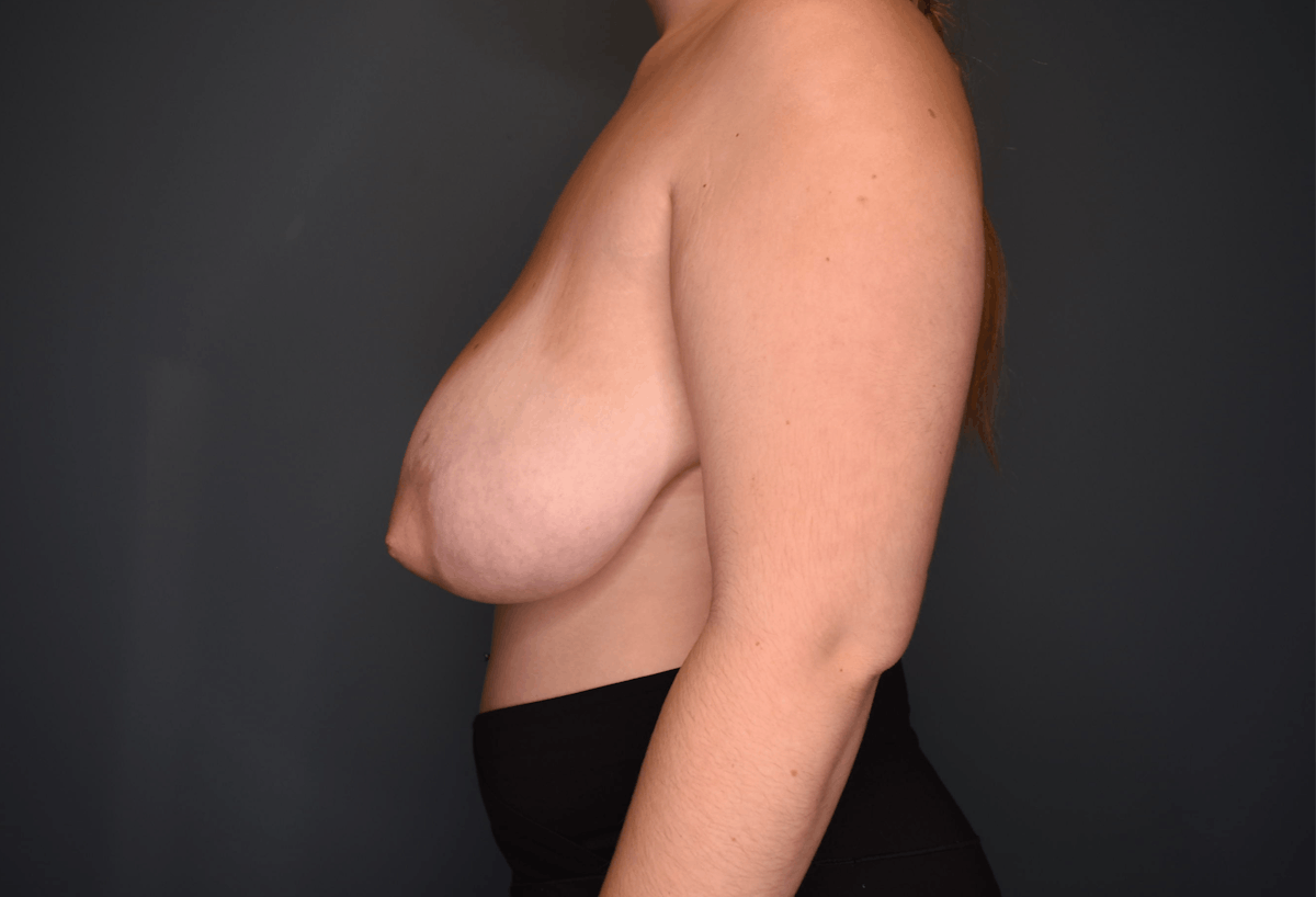 Breast Reduction Before & After Gallery - Patient 219006 - Image 7