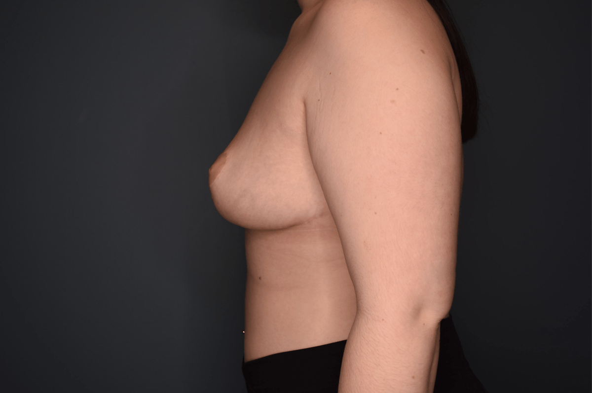 Breast Reduction Before & After Gallery - Patient 219006 - Image 8