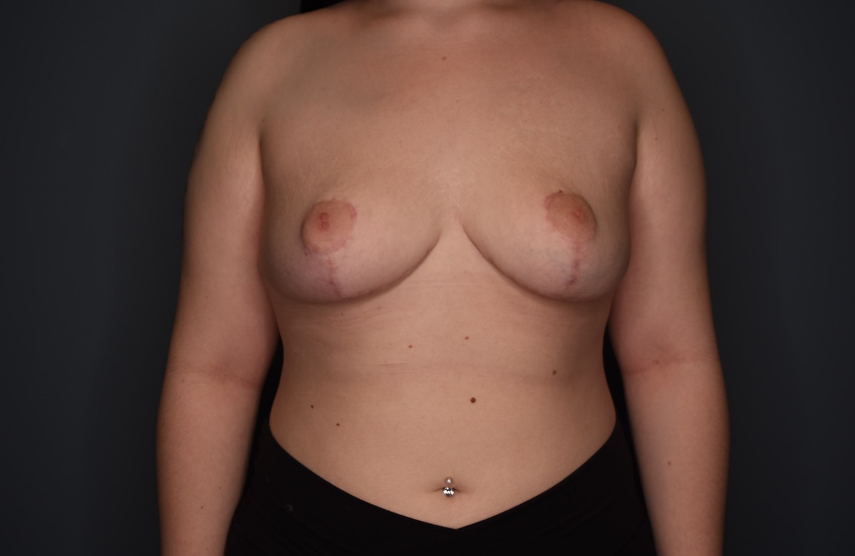 Breast Reduction Before & After Gallery - Patient 219006 - Image 10