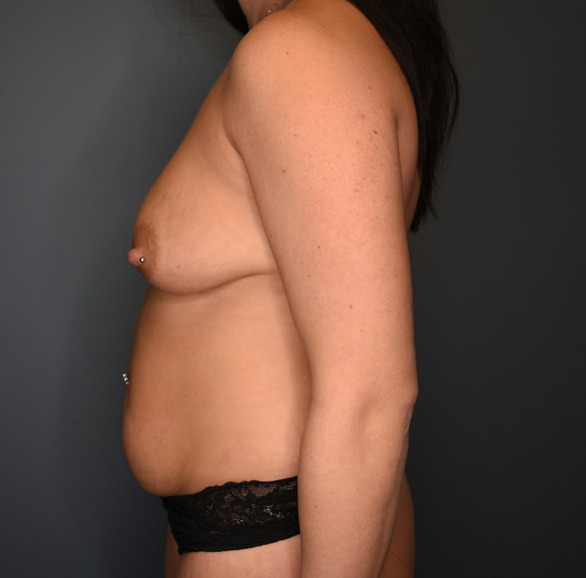 Breast and Tummy Before & After Gallery - Patient 945726 - Image 1