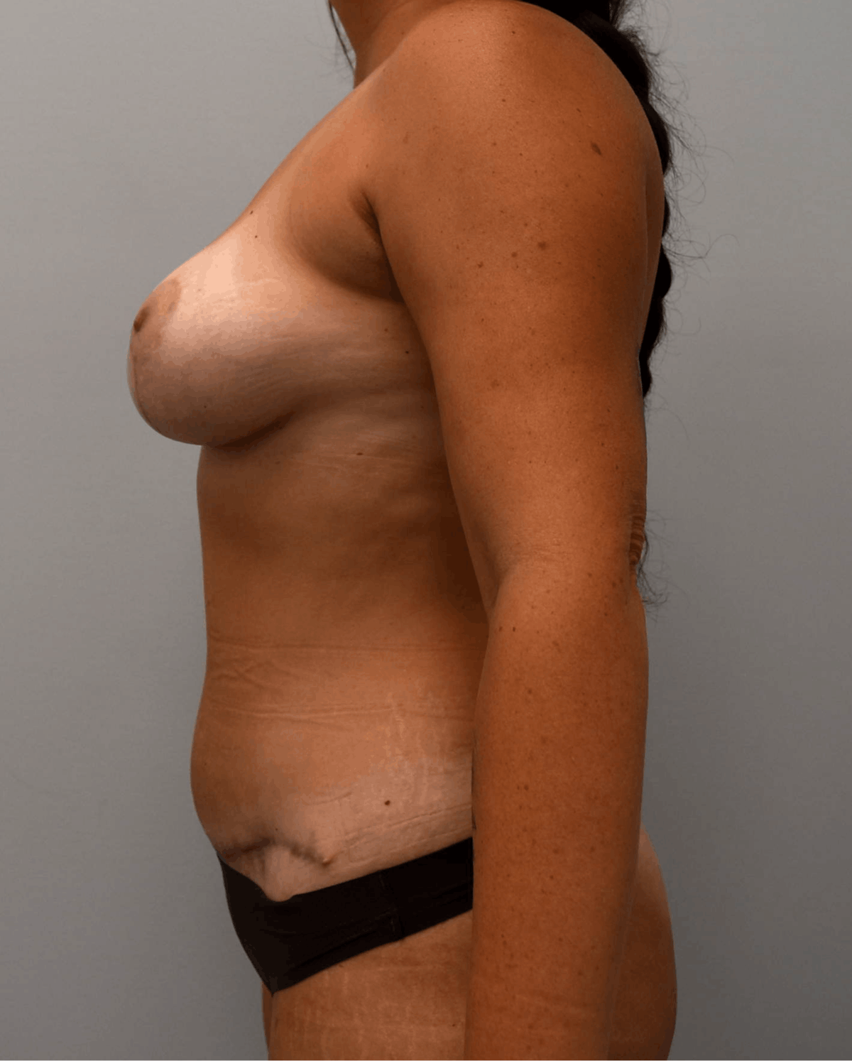 Breast and Tummy Before & After Gallery - Patient 248447 - Image 2