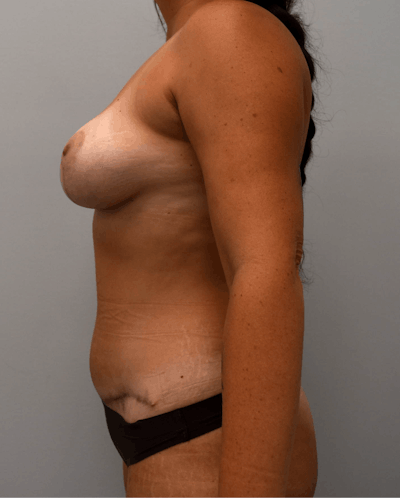 Breast and Tummy Before & After Gallery - Patient 248447 - Image 2