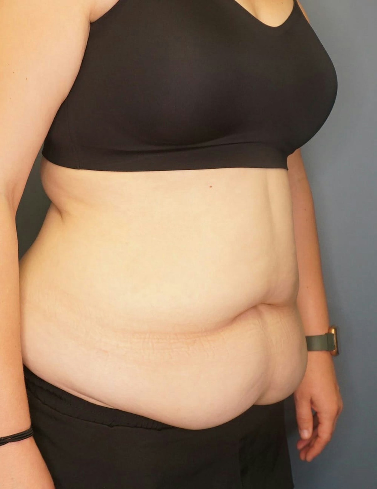 Tummy Tuck Before & After Gallery - Patient 212891 - Image 3