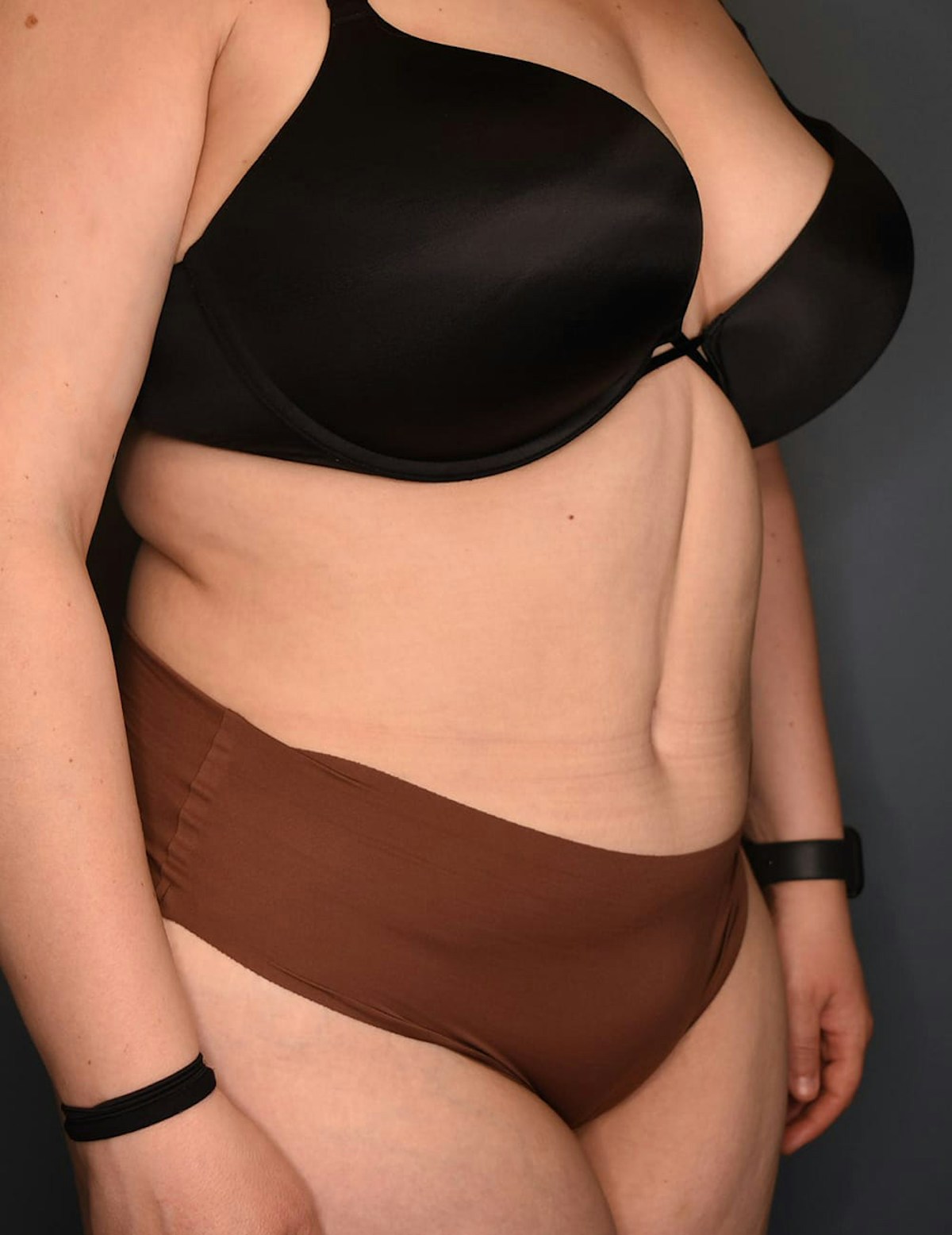 Tummy Tuck Before & After Gallery - Patient 212891 - Image 4