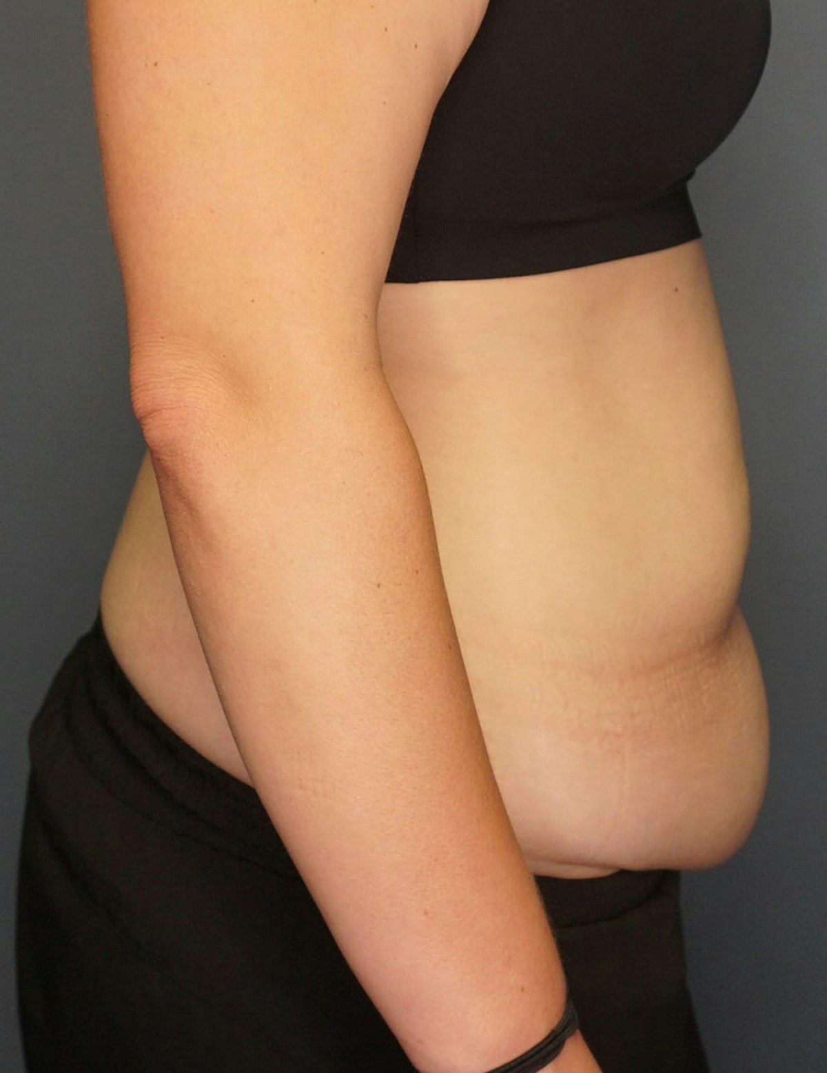 Tummy Tuck Before & After Gallery - Patient 212891 - Image 5