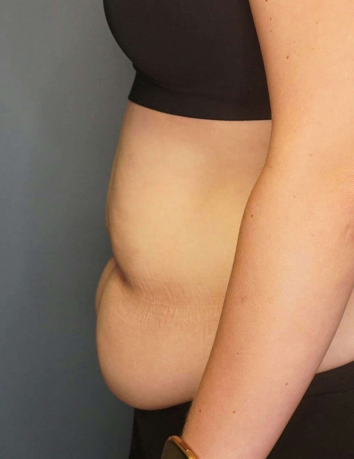 Tummy Tuck Before & After Gallery - Patient 212891 - Image 9
