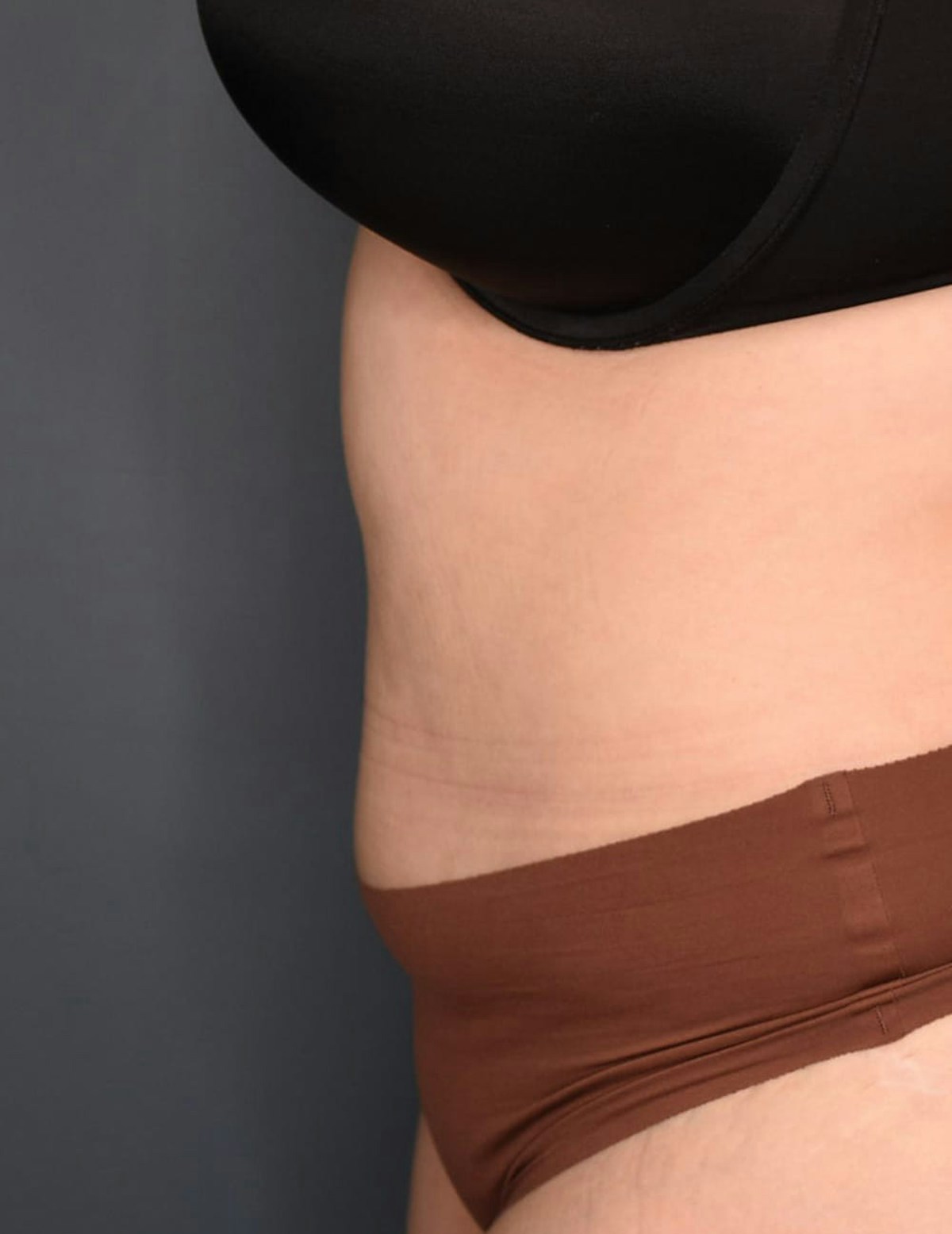 Tummy Tuck Before & After Gallery - Patient 212891 - Image 10