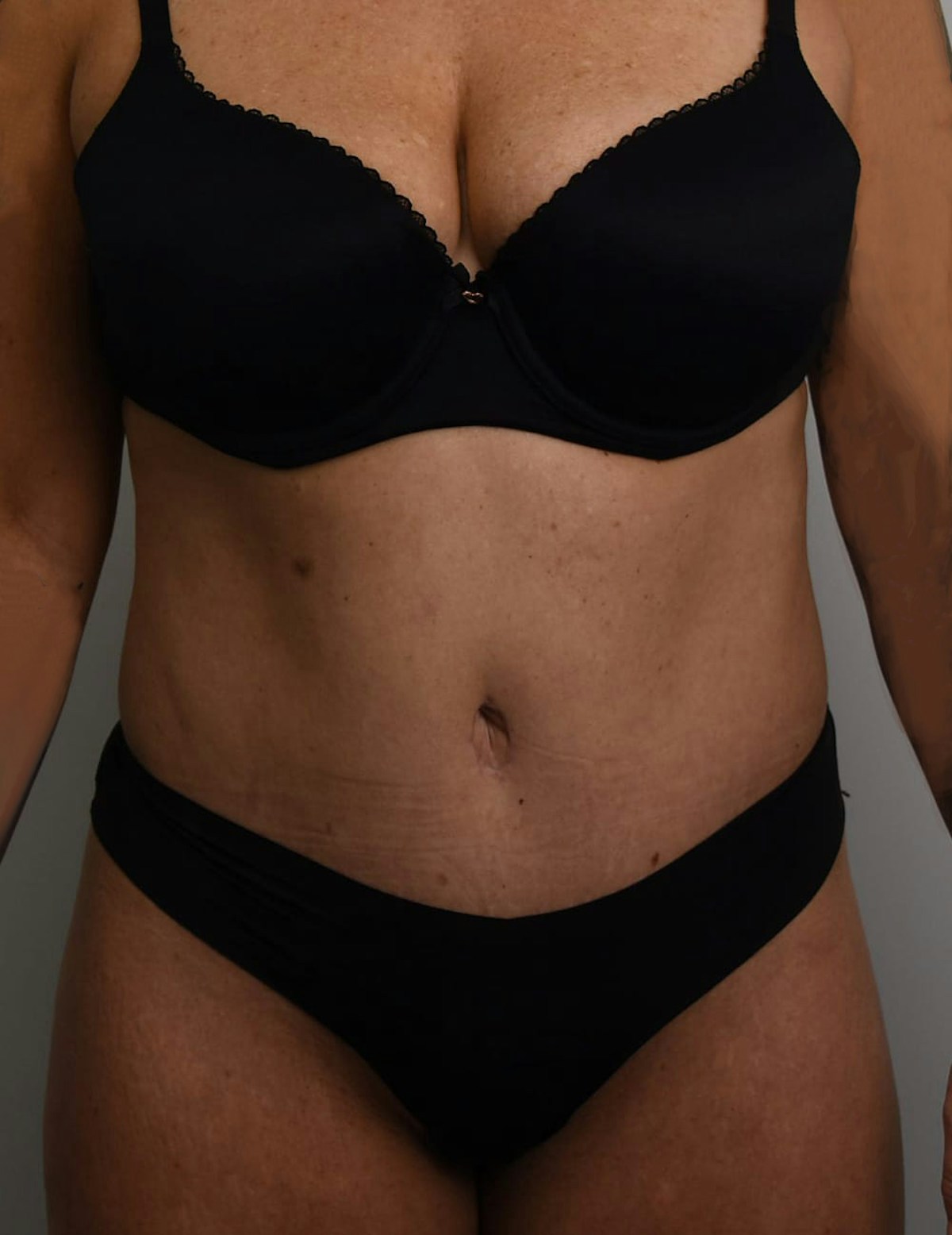 Tummy Tuck Before & After Gallery - Patient 421666 - Image 2