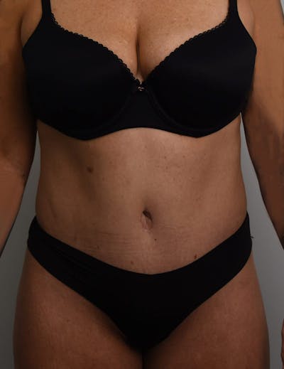 Tummy Tuck Before & After Gallery - Patient 421666 - Image 2