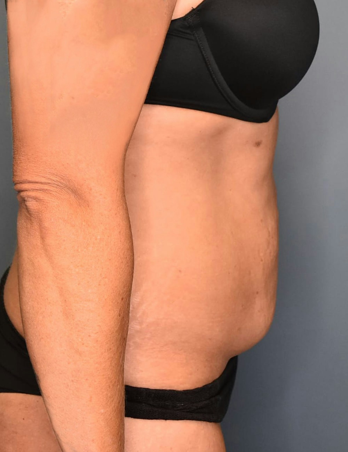 Tummy Tuck Before & After Gallery - Patient 421666 - Image 5