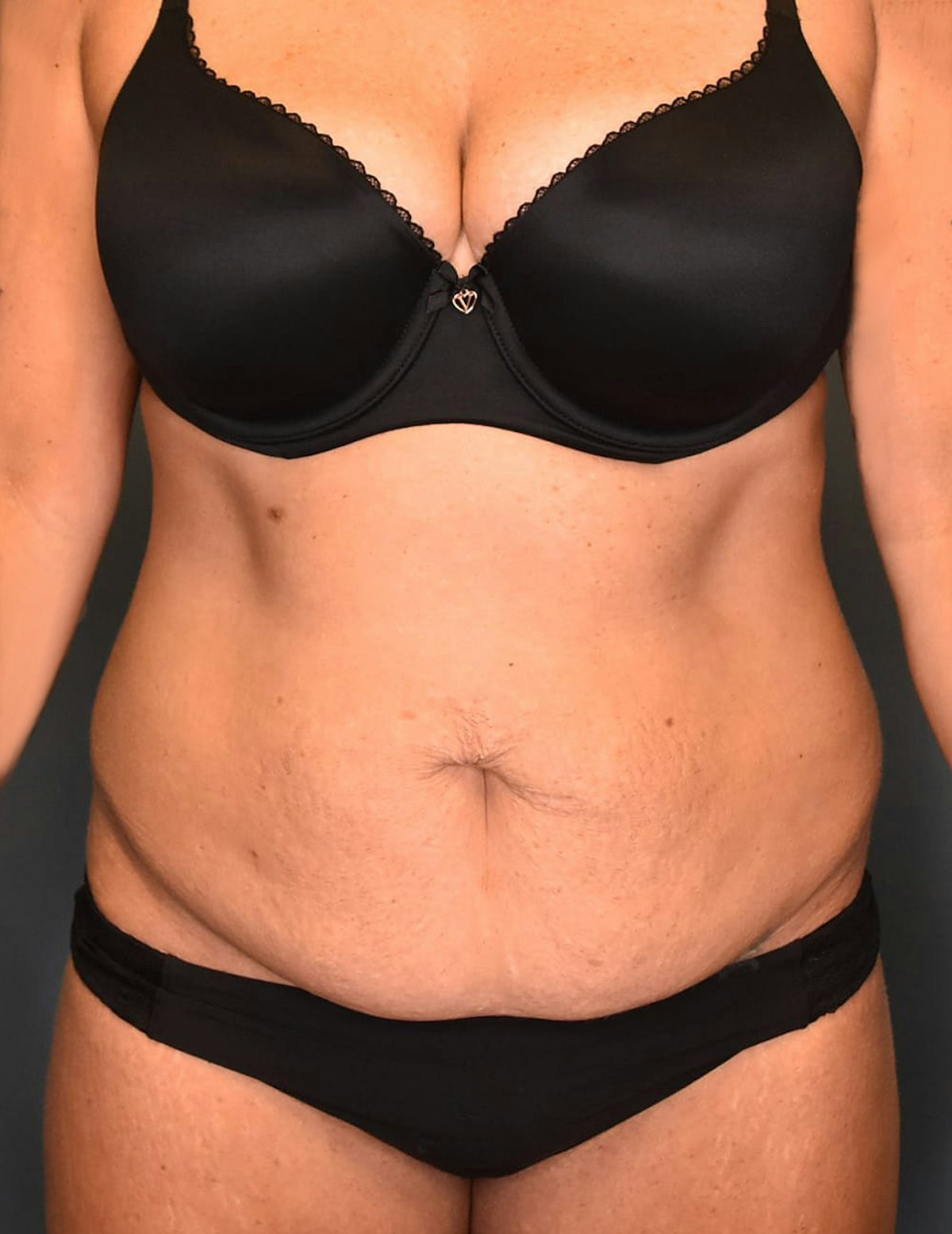 Tummy Tuck Before & After Gallery - Patient 421666 - Image 1
