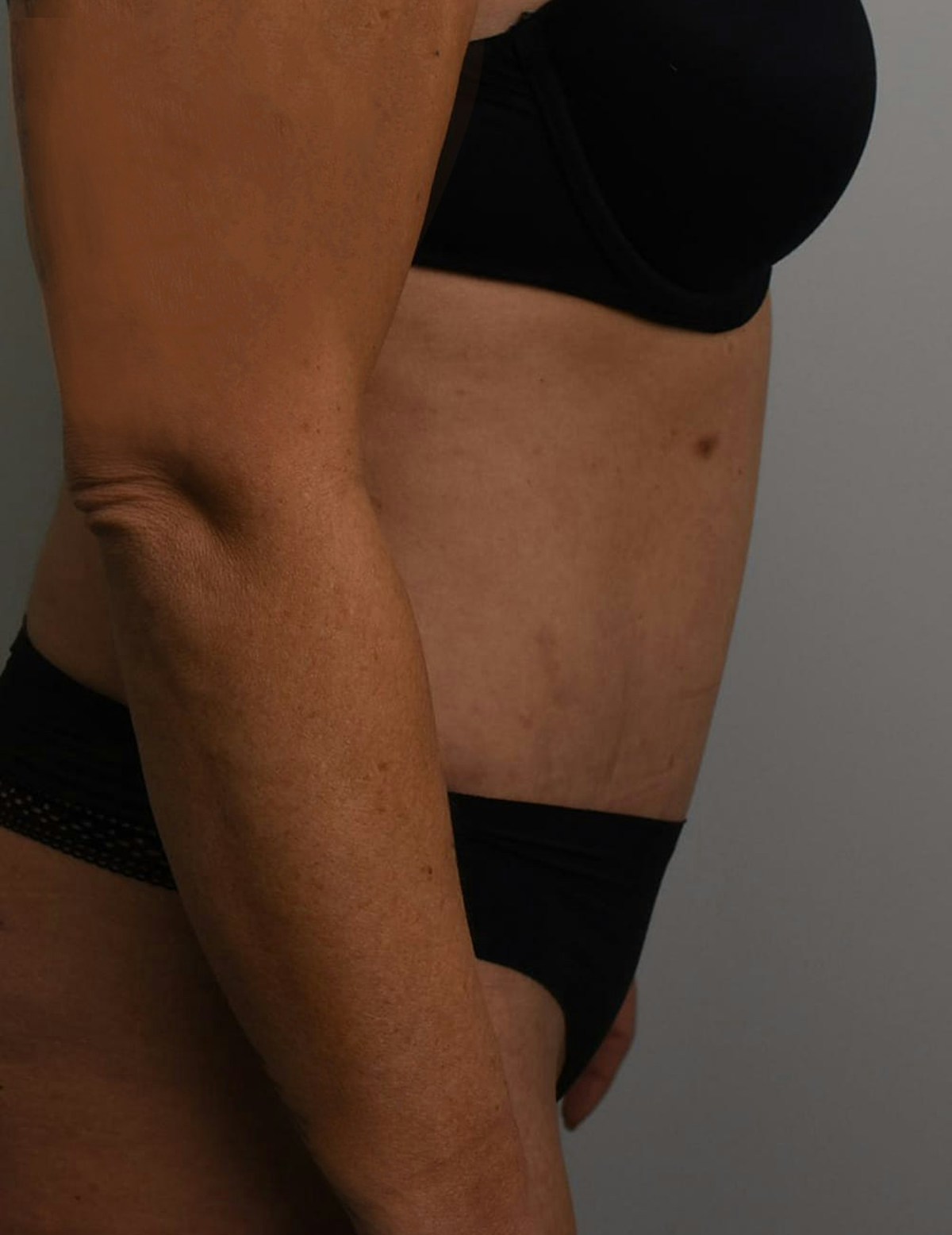 Tummy Tuck Before & After Gallery - Patient 421666 - Image 6