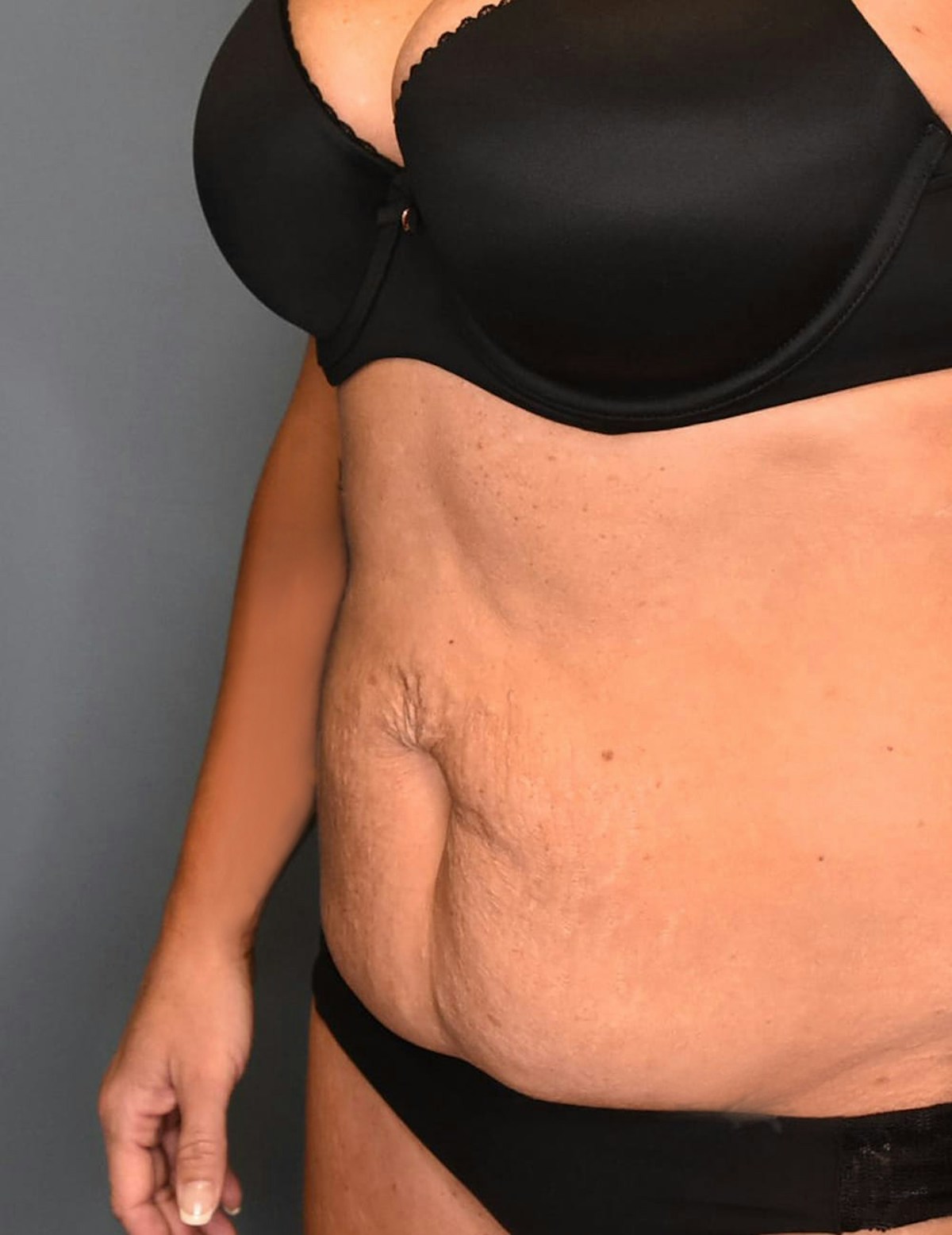Tummy Tuck Before & After Gallery - Patient 421666 - Image 7