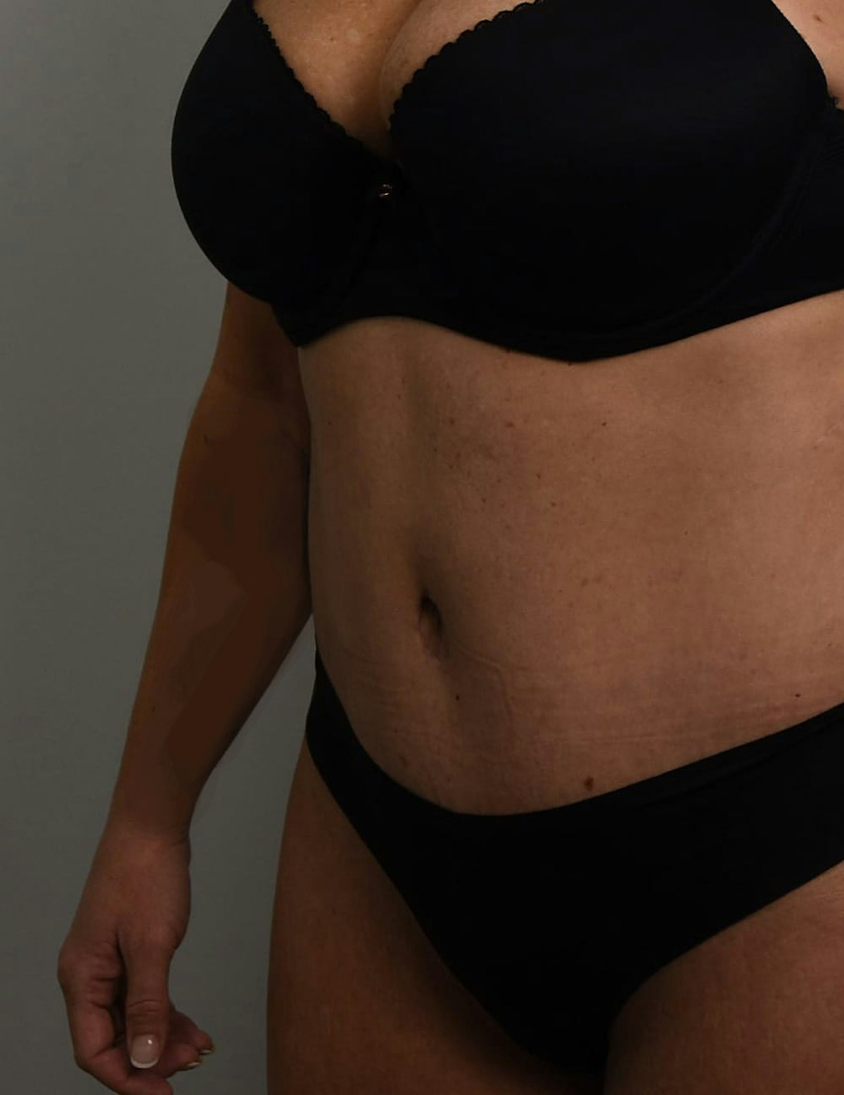 Tummy Tuck Before & After Gallery - Patient 421666 - Image 8