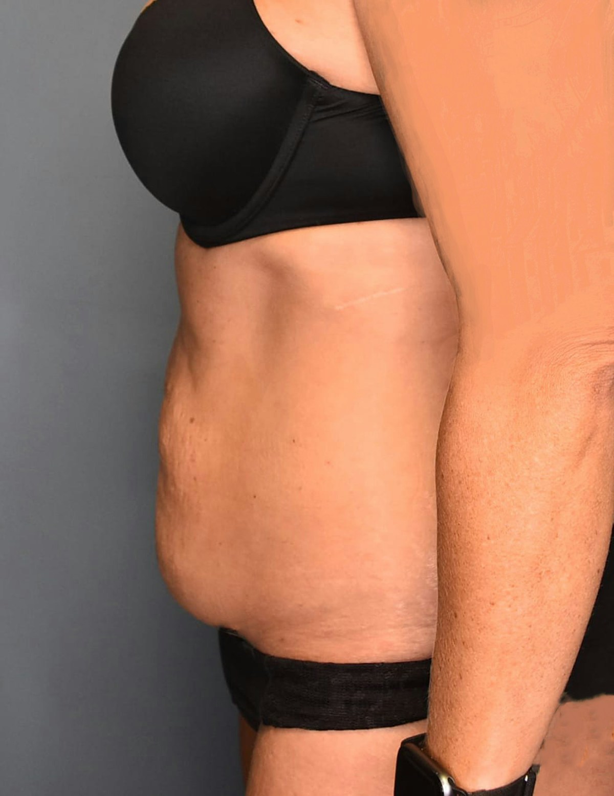 Tummy Tuck Before & After Gallery - Patient 421666 - Image 9