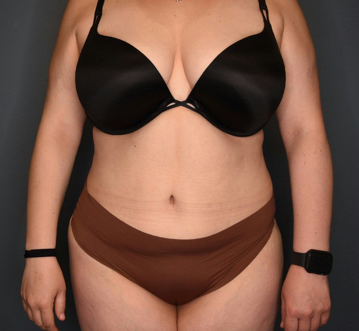 Tummy Tuck Before & After Gallery - Patient 118533 - Image 2