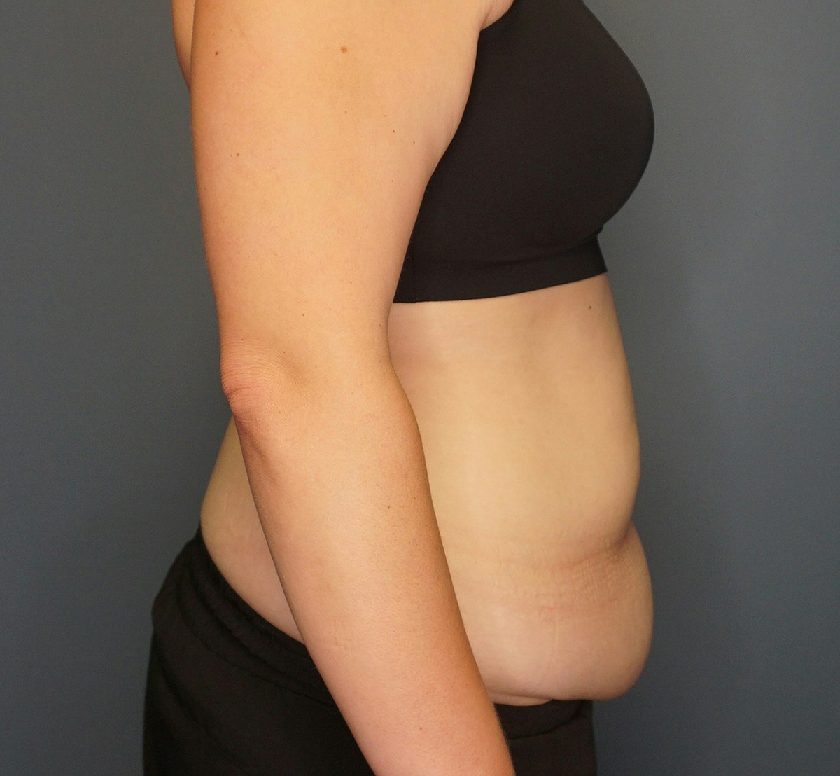 Tummy Tuck Before & After Gallery - Patient 118533 - Image 5