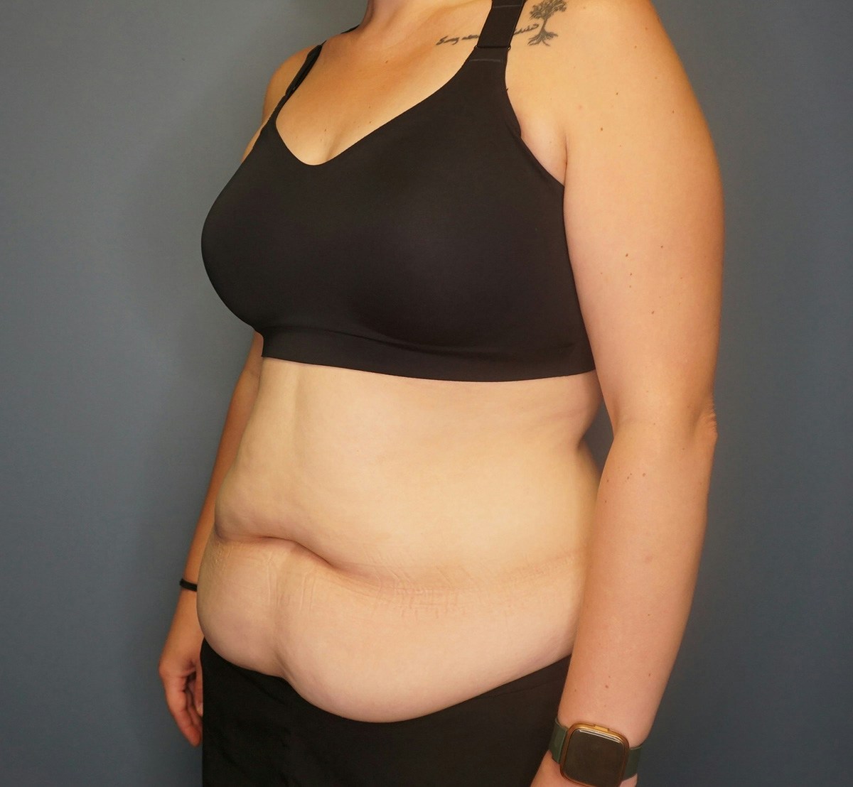 Tummy Tuck Before & After Gallery - Patient 118533 - Image 7
