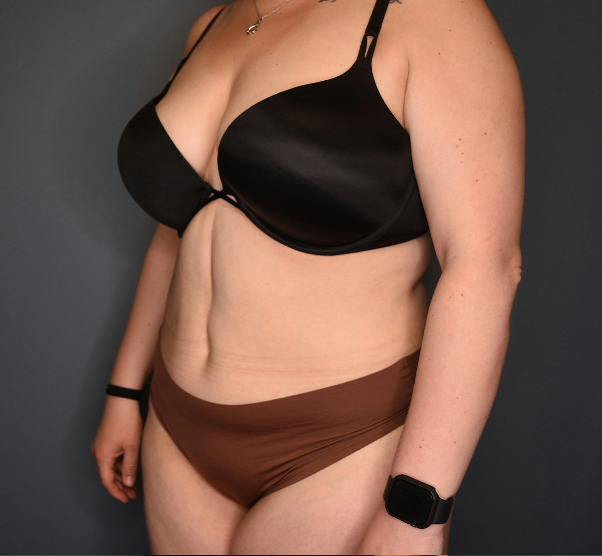 Tummy Tuck Before & After Gallery - Patient 118533 - Image 8