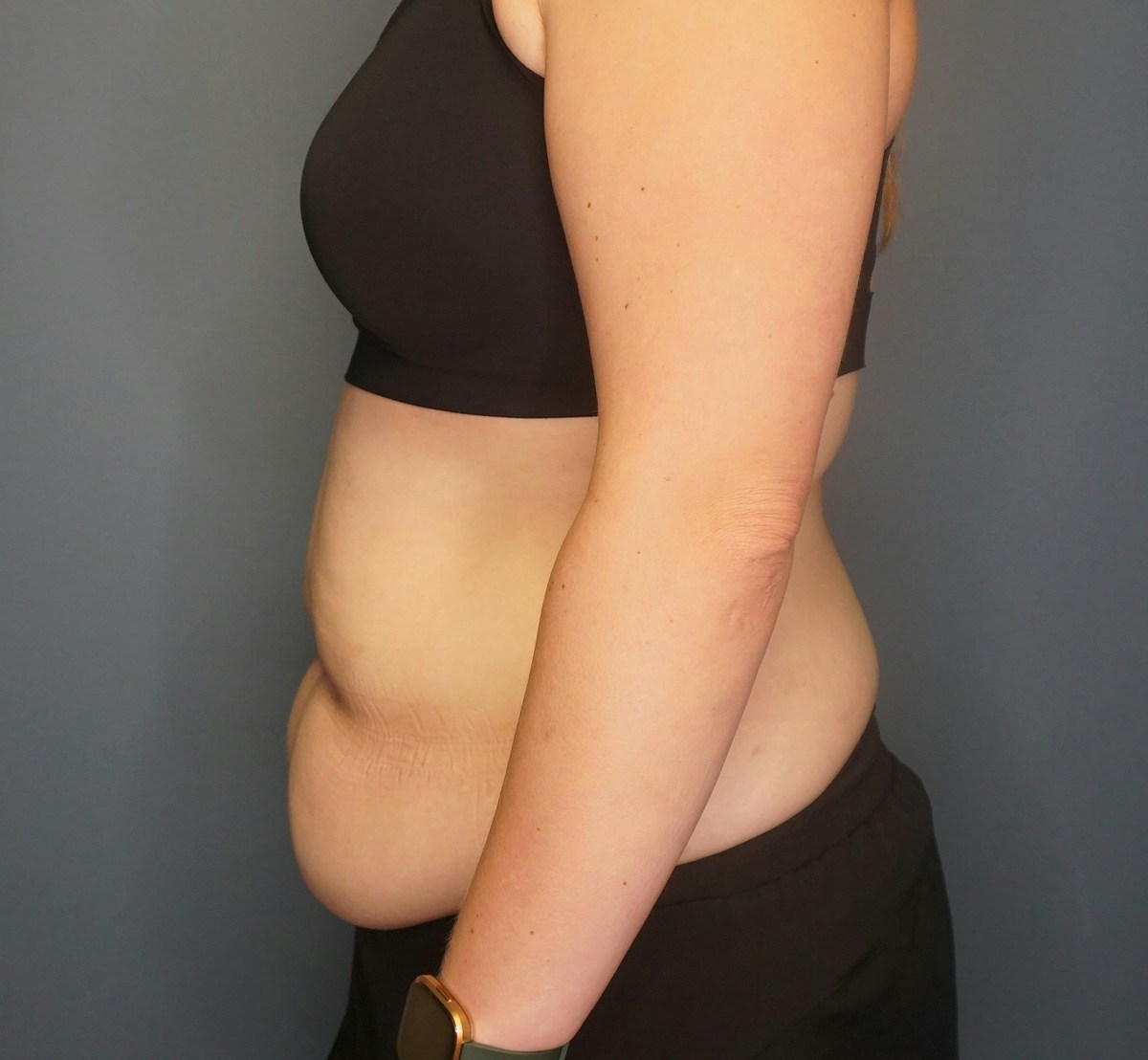 Tummy Tuck Before & After Gallery - Patient 118533 - Image 9