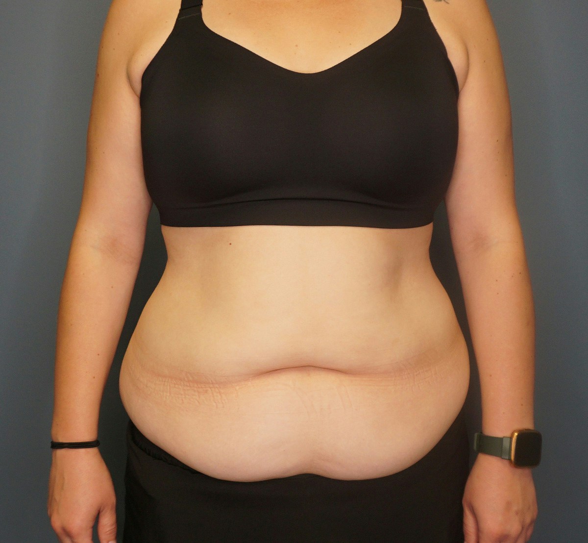 Tummy Tuck Before & After Gallery - Patient 118533 - Image 1
