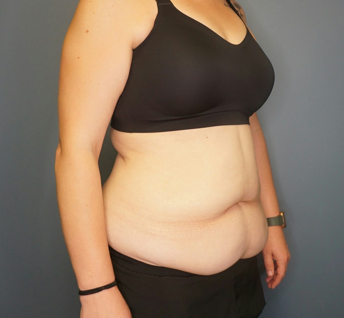 Tummy Tuck Before & After Gallery - Patient 118533 - Image 3