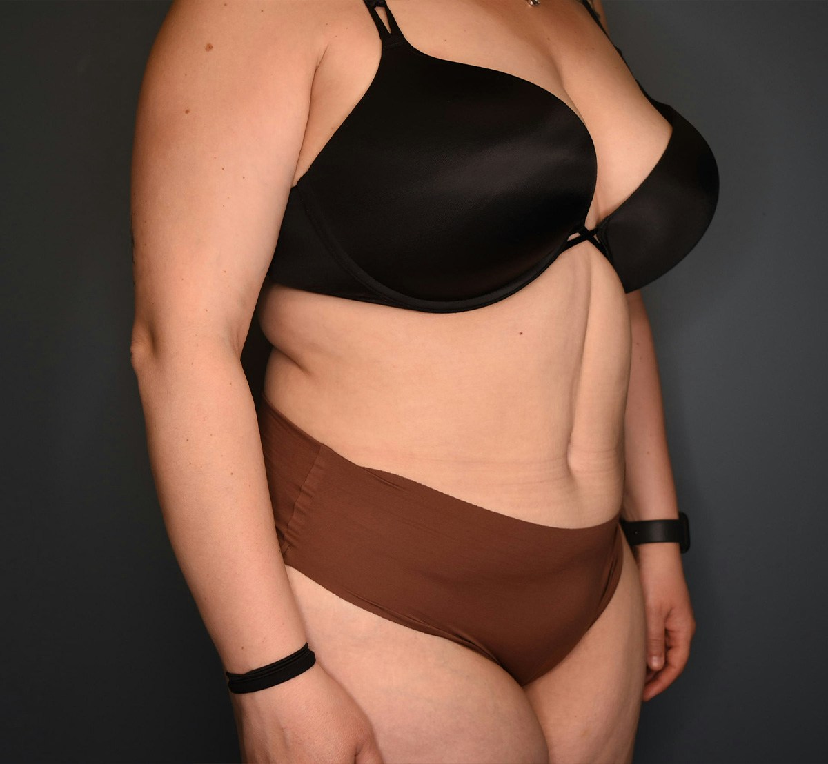 Tummy Tuck Before & After Gallery - Patient 118533 - Image 4
