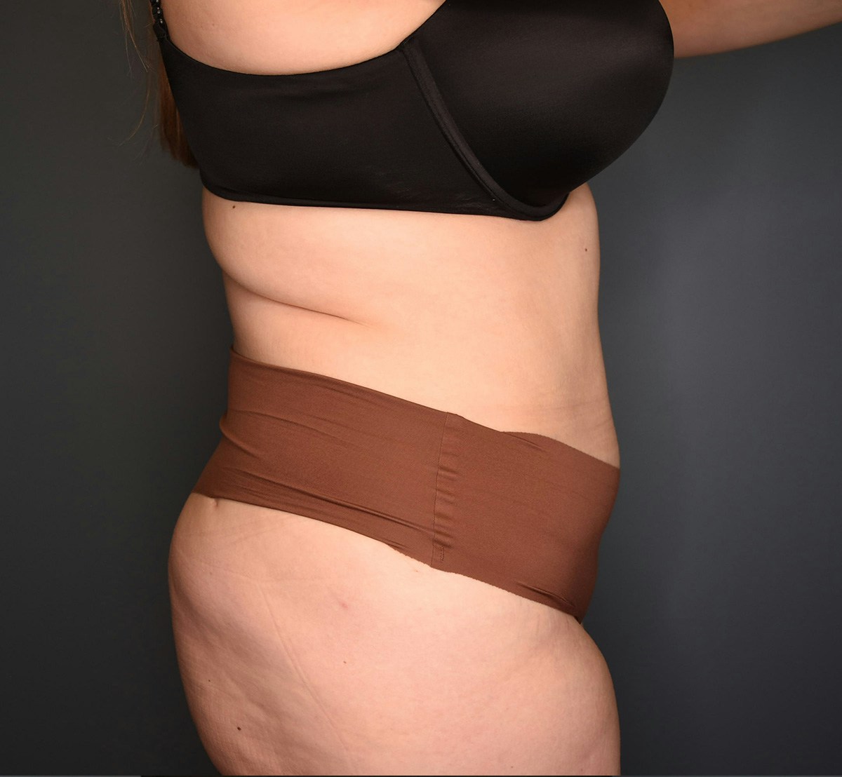 Tummy Tuck Before & After Gallery - Patient 118533 - Image 6