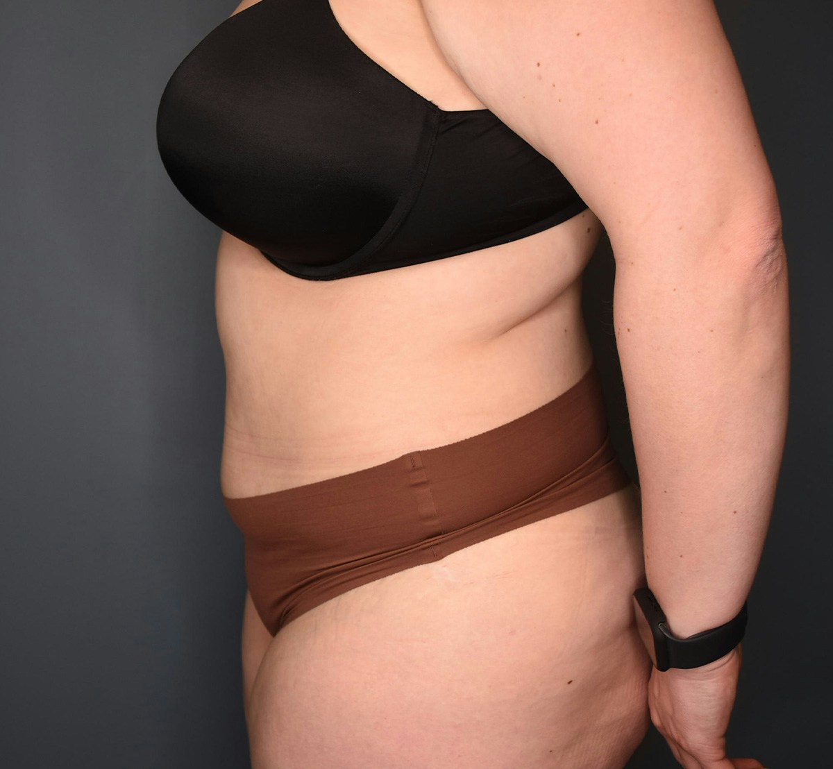 Tummy Tuck Before & After Gallery - Patient 118533 - Image 10