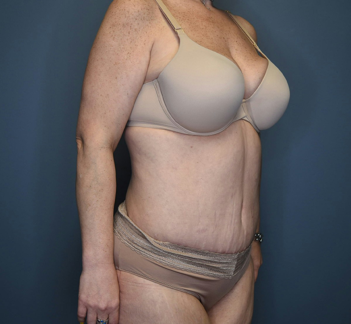 Tummy Tuck Before & After Gallery - Patient 798387 - Image 4