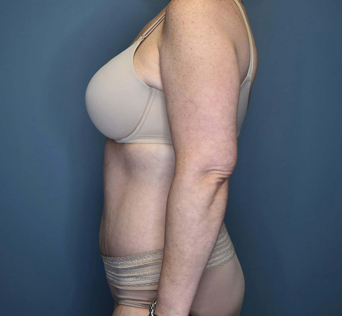 Tummy Tuck Before & After Gallery - Patient 798387 - Image 8