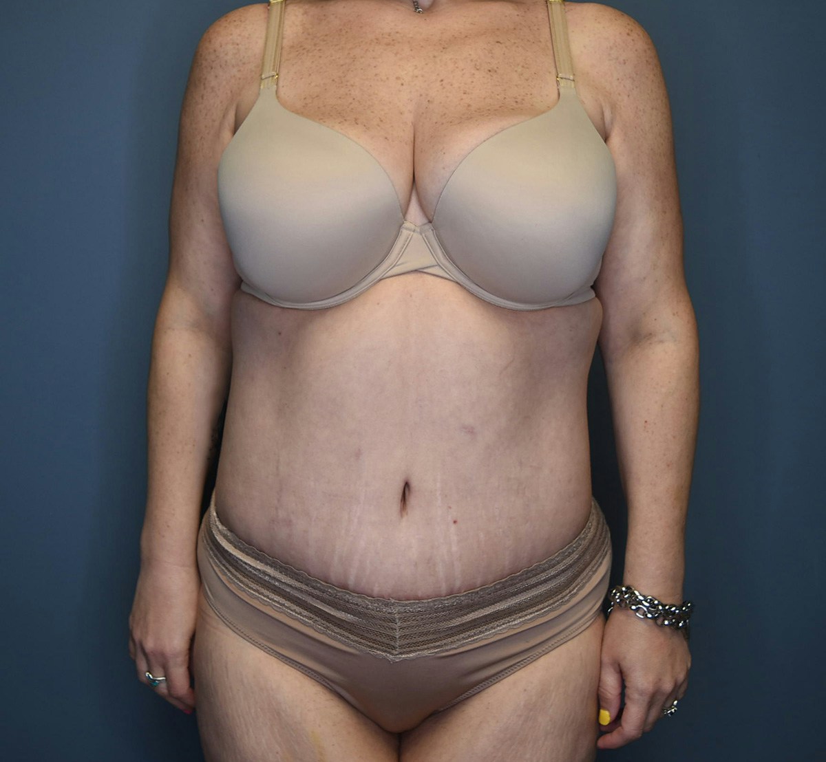 Tummy Tuck Before & After Gallery - Patient 798387 - Image 2