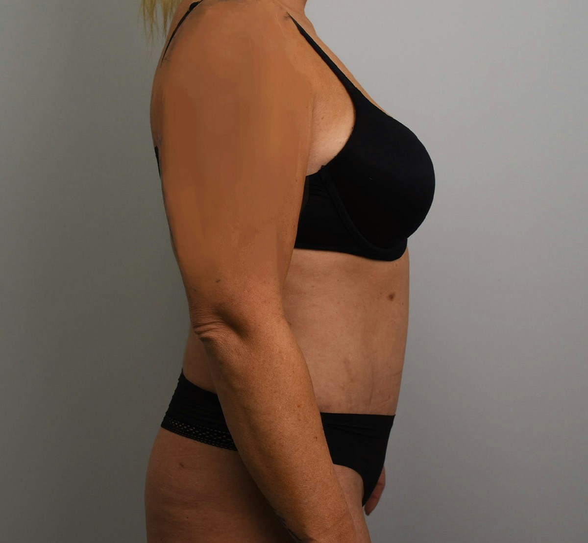 Tummy Tuck Before & After Gallery - Patient 323128 - Image 6