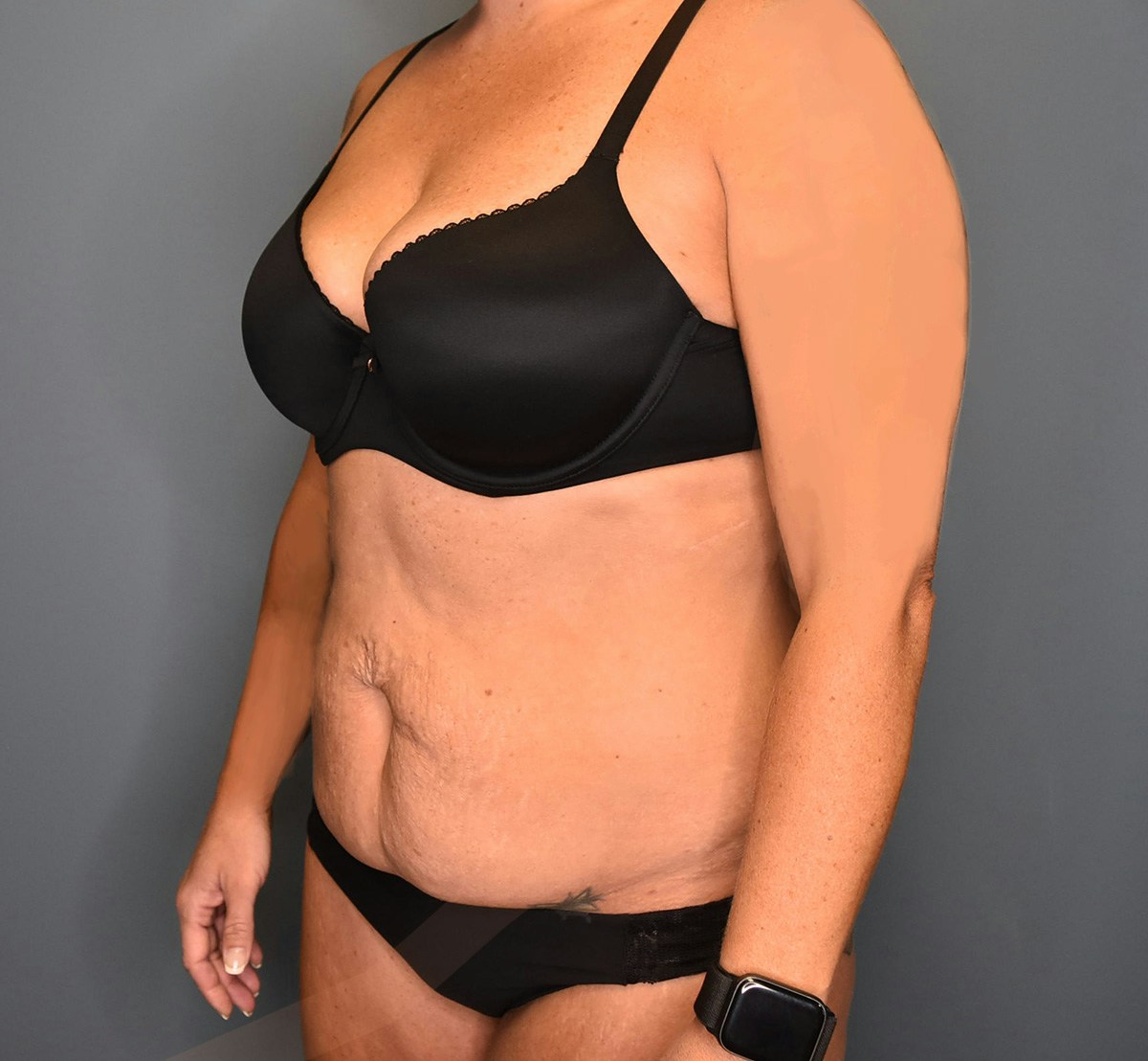 Tummy Tuck Before & After Gallery - Patient 323128 - Image 7