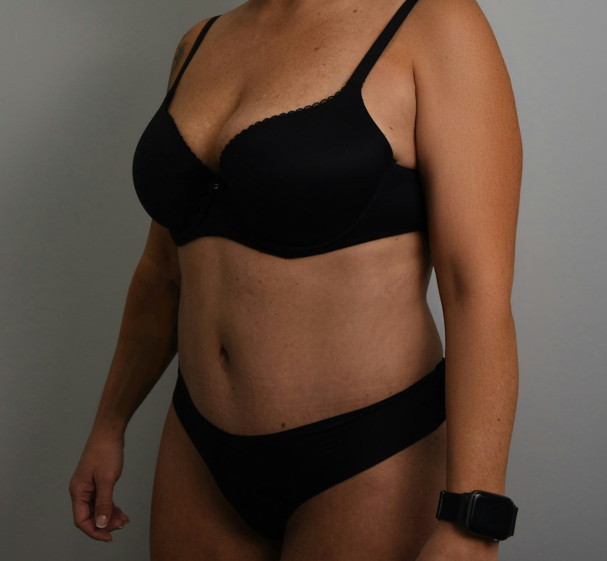 Tummy Tuck Before & After Gallery - Patient 323128 - Image 8