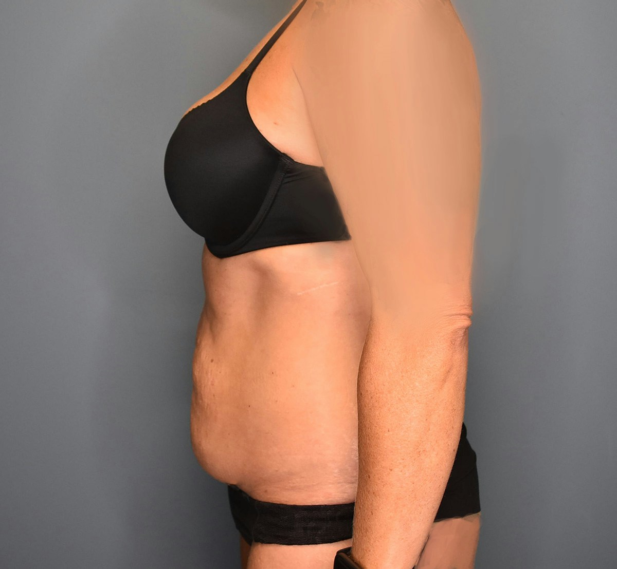 Tummy Tuck Before & After Gallery - Patient 323128 - Image 9